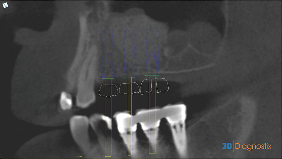 CAD-CAM Surgical Guides for Implantology: The New, The Old and The ...