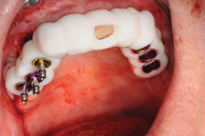 Per-operatory photograph, showing the surgical guide with right side implants in place.