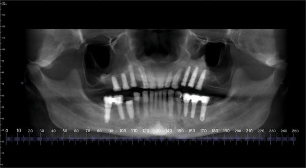CAD-CAM Surgical Guides for Implantology: The New, The Old and The ...
