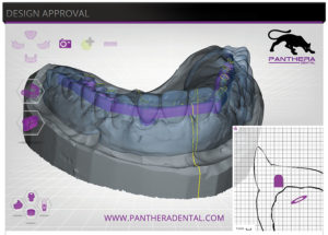 Screenshot of CAD CAM implant supported bar at the design stage.