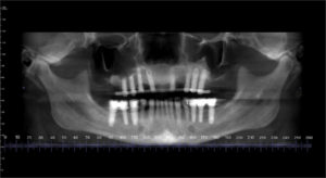 Post-op scan after implant-supported bar placement.