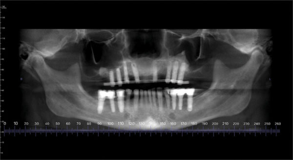 CAD-CAM Surgical Guides for Implantology: The New, The Old and The ...