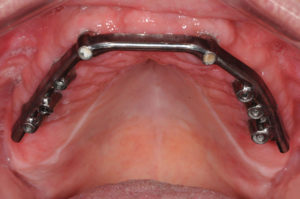 The final implant-supported bar.