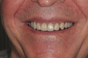 The patient's smile shown with the final prosthesis in place.