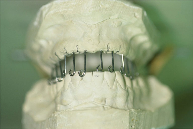 CAD-CAM Surgical Guides for Implantology: The New, The Old and The ...