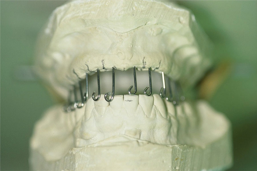 CAD-CAM Surgical Guides for Implantology: The New, The Old and The ...