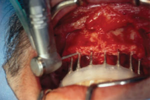 Use of the bins to guide the osteotomy.