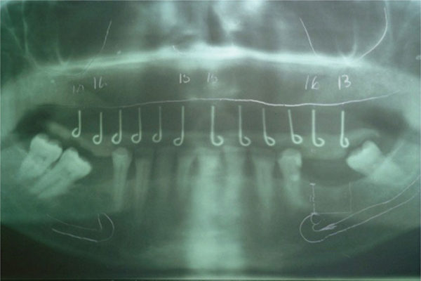 CAD-CAM Surgical Guides for Implantology: The New, The Old and The ...