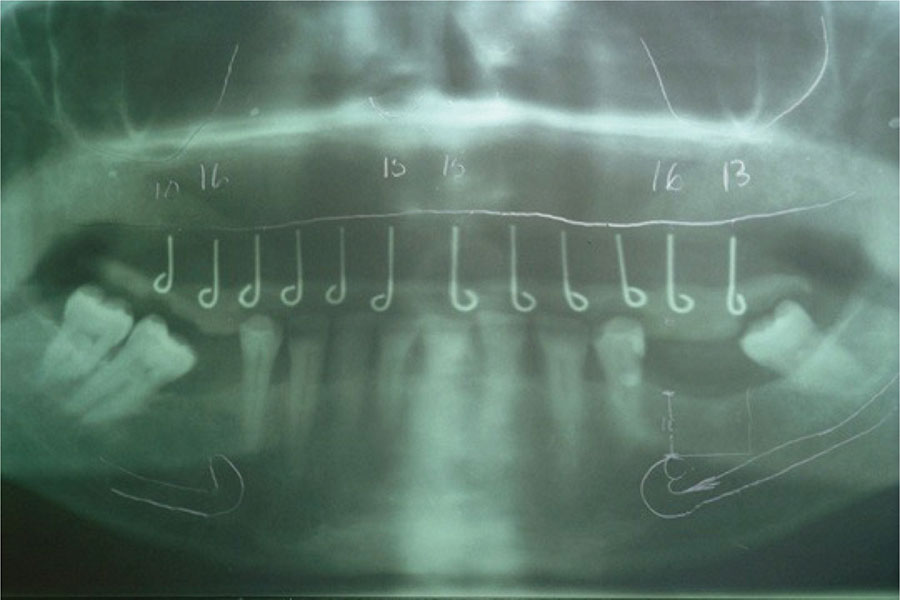 CAD-CAM Surgical Guides for Implantology: The New, The Old and The ...