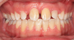 Figures 4 and 5 show the final orthodontic position with 13, 23 in the position of (formerly extracted) 11 and 21.