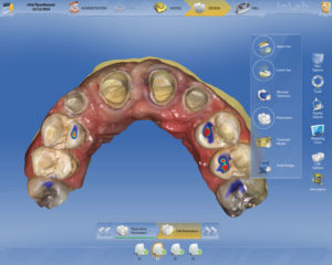 Figures 8 and 9 show occlusal and anterior scanned images from CEREC’s OmniCAM.