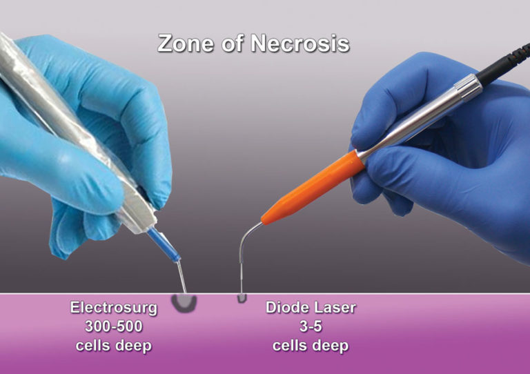 Diode Laser for Implant Uncovery and Soft Tissue Modification