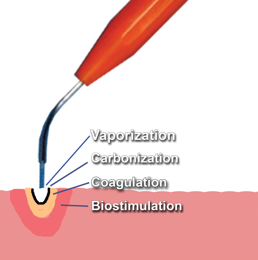 Diode Laser for Implant Uncovery and Soft Tissue Modification