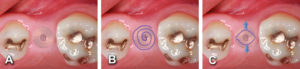 Implant to be uncovered (A) presents with two options depending on width of attached gingiva available. Wide band of attached gingiva will remain after removal of tissue over cover screw, the diode is utilizes in a spiral pattern starting at center until fully exposed (B). Narrow band of attached gingiva present, an elliptical cut i made with the diode and tissue is pushed buccally and lingually to preserve the attached gingiva (C).