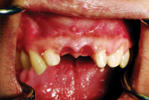 Buccal view of the anterior maxilla demonstrating preservation of the papilla die to the provisional bridge.