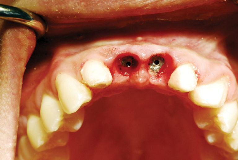 Diode Laser for Implant Uncovery and Soft Tissue Modification