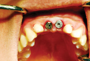 Healing abutments placed into the implants.