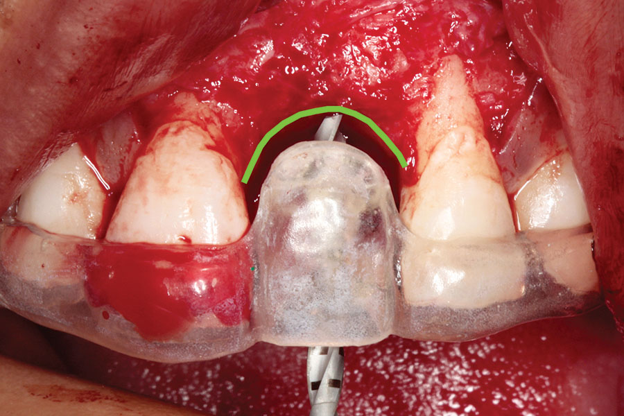 dabuleanu25osteotomysitedevelopmentusingsurgicalstent Oral