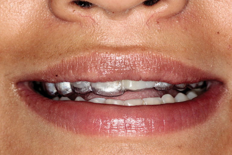 dabuleanu30insertionofessixappliance Oral Health Group