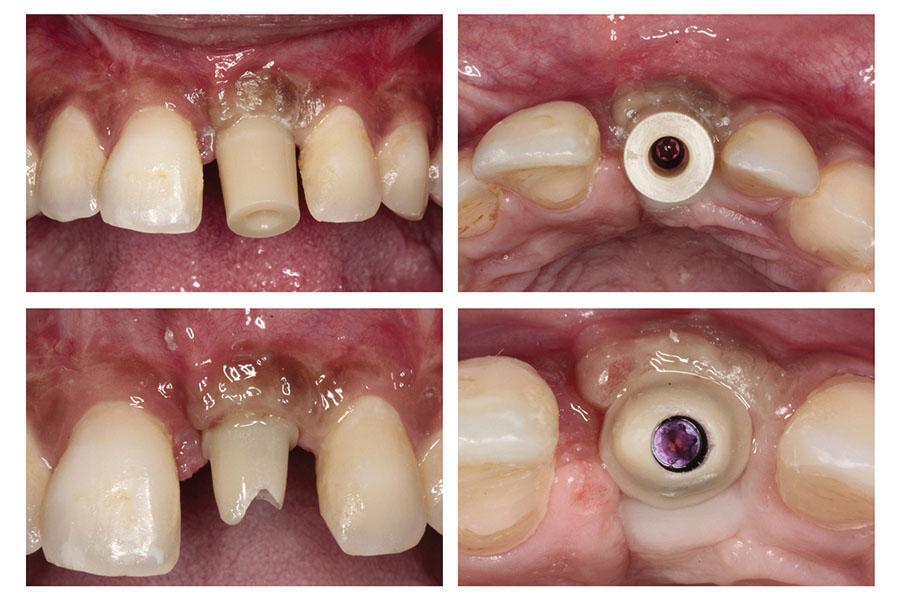 A Stepwise Approach Restoring a Failed Maxillary Anterior Tooth