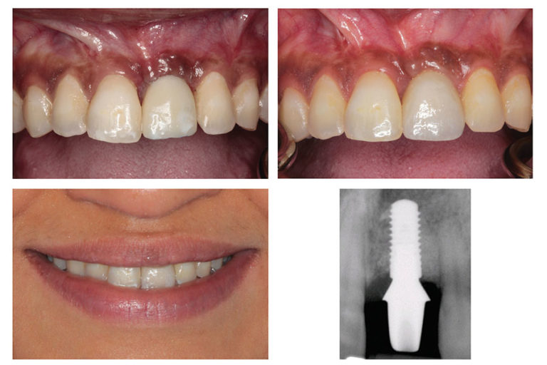 dabuleanu42provisionalandfinalimplantcrownswithradiograph