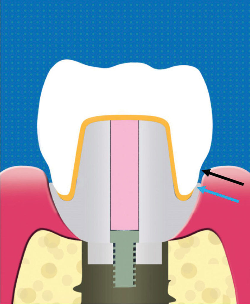 Dental Implant Prosthetics Using a Modified Installation Technique