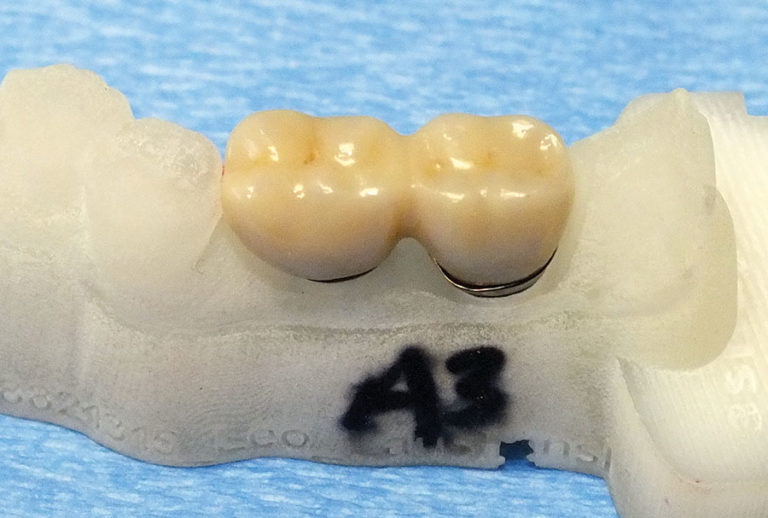 Dental Implant Prosthetics Using a Modified Installation Technique