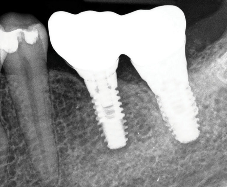 Dental Implant Prosthetics Using a Modified Installation Technique