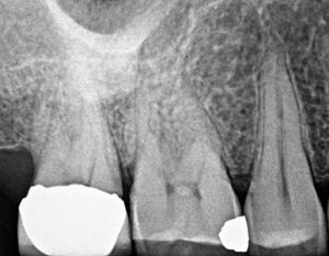 The traditional flat film used to pre-operatively asses number of roots, the degree of calcification and the planar geometries of the roots along their length has now been augmented by axial slices which assist in identification of the number of canals and various anatomical configurations and aberrations.