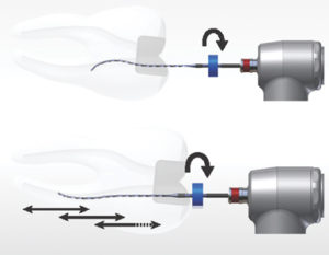 The Finisher is used for 1 minute using slow and gentle 7 to 8 mm lengthwise movements to the contact the full length of the canal and after that period removed from the canal while rotating.