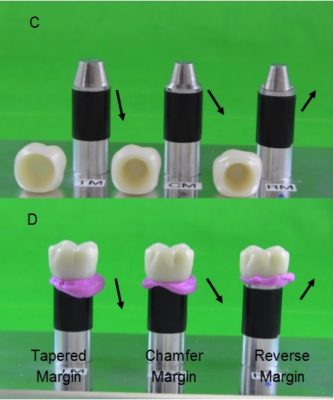 Controlling Excess Cement During the Process of Intra-Oral Prosthesis ...