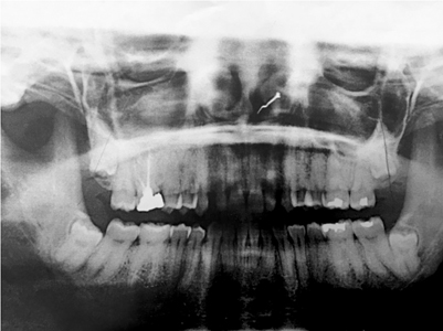 Pre Extraction Radiograph A Rare Complication of a Retrobulbar Hematoma Formation