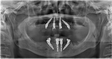 Maxillary and Mandibular 4 Implants for All-In-1 Arch Protocol.