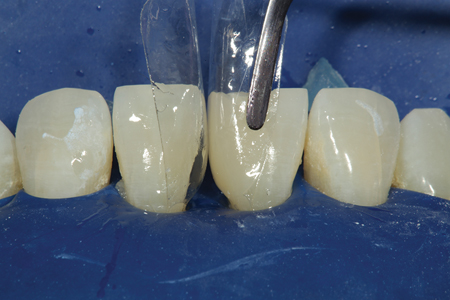 One side of the diastema closure is seen after “injection molding” with heated composite resin. Once light cured, the proximal area of the restorative material should not be touched! The finish from the Mylar is smoother than any polishing instrument could achieve and the emergence profiles of the composite will never be better than at matric removal. Any finishing and polishing will be performed as needed on facial and lingual surfaces to blend the restorative material into the natural tooth surface.