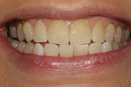 A smile view of the completed diastema closure.