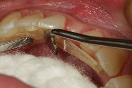 Fiber reinforcement is being placed on the lingual aspect to support the pontic and act as an orthodontic retainer as well.