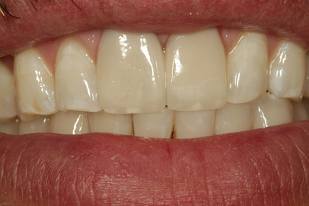 A postoperative smile view of the patient shown in Figure 13. Some white composite tint was placed at the incisal edge on the dentin layer prior to placement of the enamel increment to better match the patients’ natural surrounding teeth.