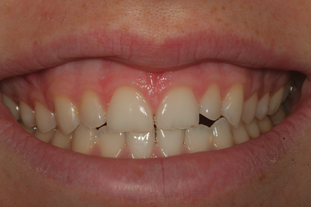 A preoperative smile view of a female teenage patient that has aesthetic and functional issues with tooth numbers 7 to 10. She is not financially able to afford ceramic veneers and the minimal amount of overjet and functional concerns could limit the longevity of traditional composite bonding.