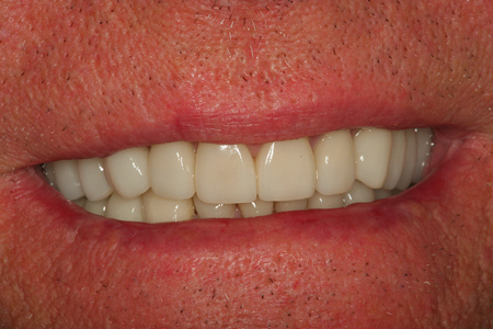 A five-year postoperative view of the aesthetic reconstruction of the patient shown in Figure 19. Not only has the patient taken years of the patient’s appearance, but also he has preserved his remaining tooth structure for years to come.