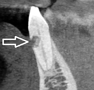 Coronal view of CBCT image of tooth 3.2, illustrating the resorptive defect.