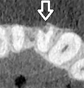 Axial view of CBCT image of tooth 2.1, showing the position of resorption.