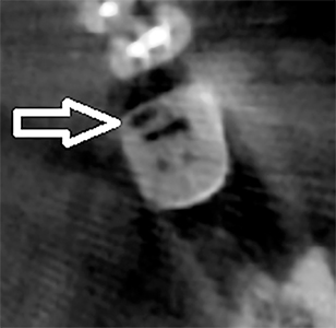 Axial view of CBCT image of tooth 3.7 illustrating the resorptive defect, involving mesial interproximal surface.