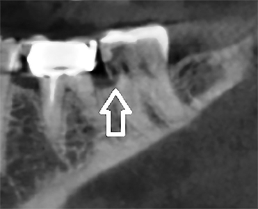 Coronal view of CBCT image of tooth 3.7, illustrating the resorptive defect at level of alveolar crest.