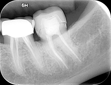 Post-operative radiograph of tooth 3.7 illustrating restored defect and temporary crown placed.