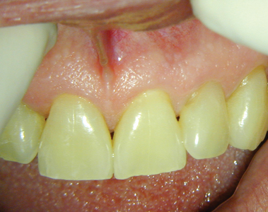 Clinical photograph of tooth 2.1, depicting normal clinical view.