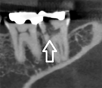 Coronal view of CBCT image of tooth 3.7, illustrating infracrestal position of resorption.