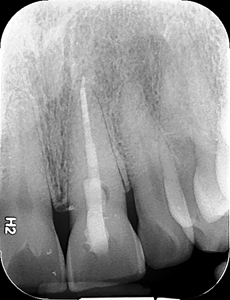 Post-operative radiograph of tooth 2.1 after completion of root canal therapy.