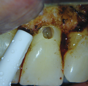 Intra-operative photograph of surgery on tooth 2.1 after removal of resorptive tissue and cavity preparation.