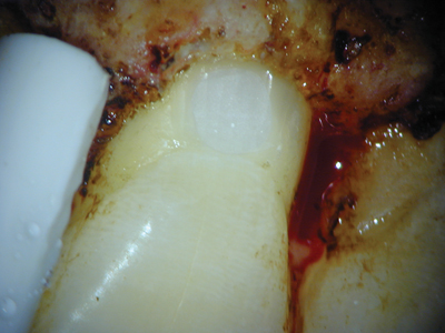 Intra-operative photograph of surgery on tooth 2.1 depicting restoration of defect using Geristore.