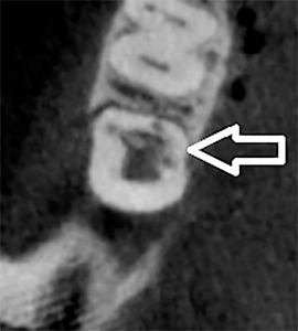 Axial view of CBCT image of tooth 4.7 illustrating the resorptive defect, involving mesial Interproximal and lingual surfaces.